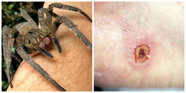 Wandering Spider Bite