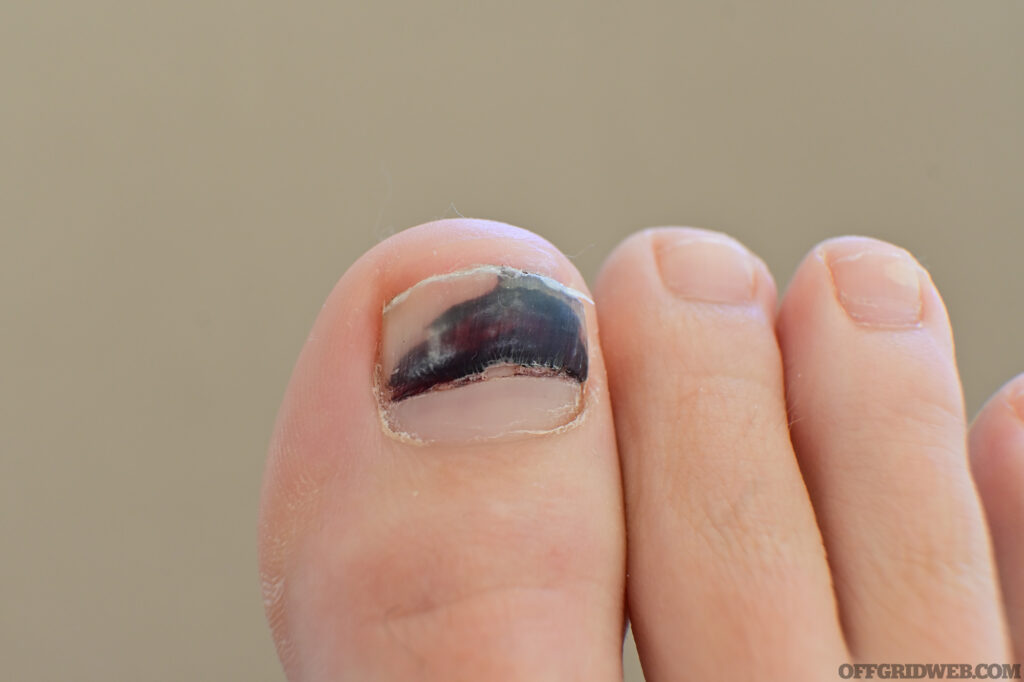 Photo shows a woman's big toe with a severe subungual hematoma on the nail.