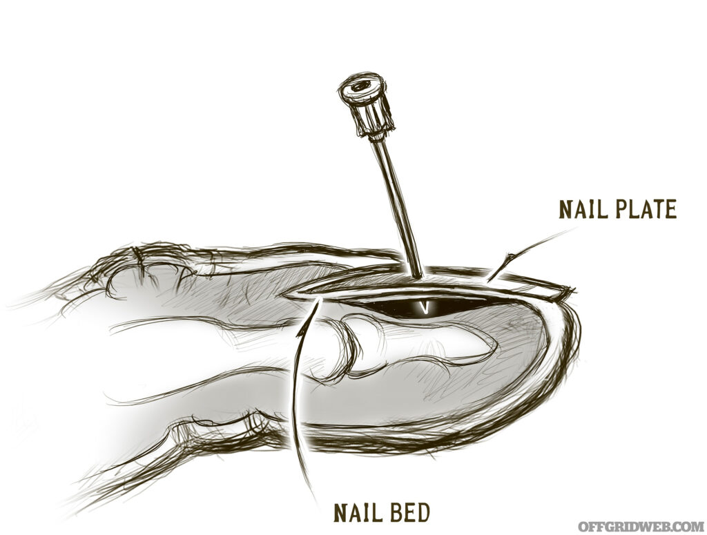 Trephination can eliminate painful hematomas under the nail.