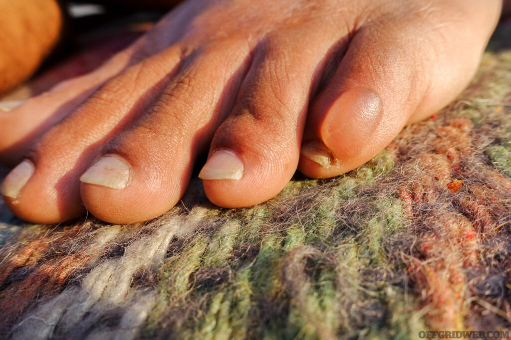 A close up shot of a water filled blister on foot due to long walks. A blister is a pocket of fluid between the upper layers of skin.