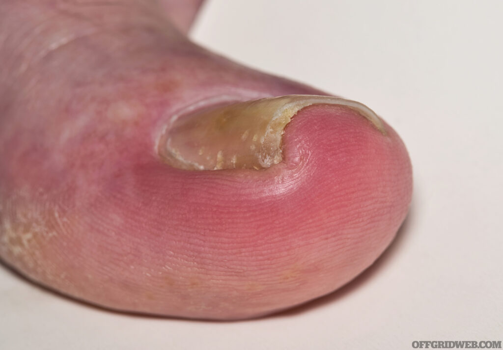 Ingrown toenail onychocryptosis on caucasian big toe Hallux, caused by fungal infection tinea unguium. Macro angled view isolated on white background.