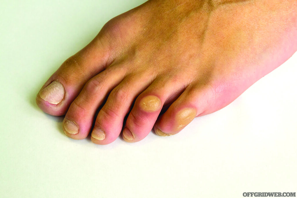 calluses on the toes close-up. foot of a man on a white background