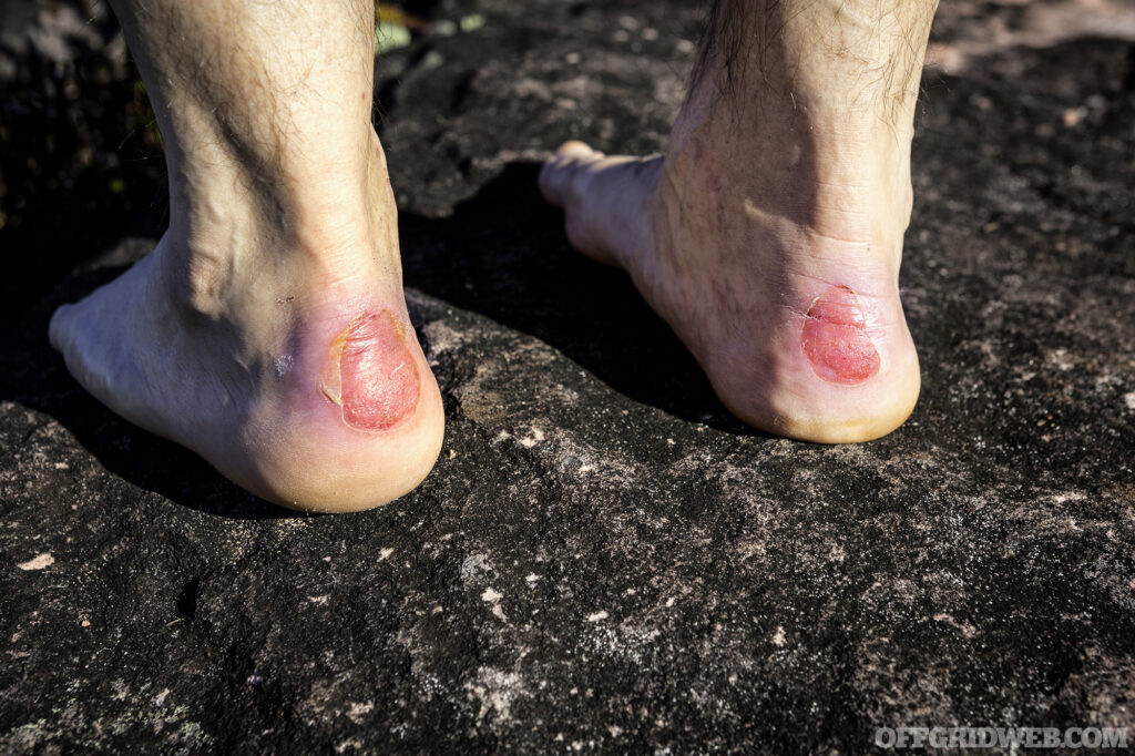 Close up of human heel with a chafe or blister and dry skin. Injury caused by new hiking shoes.