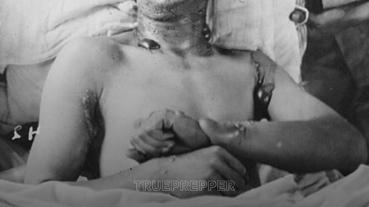 WWI Soldier with Mustard Gas Blisters on his skin