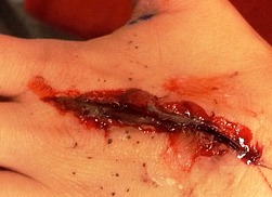 DEEP WOUND